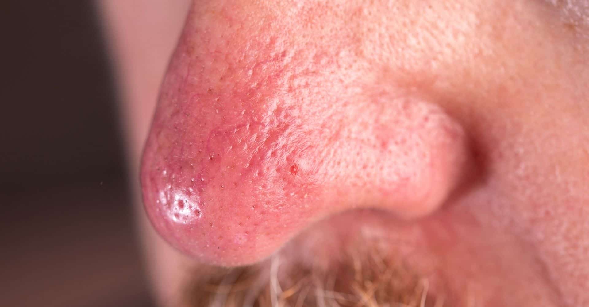 Rhinophyma surgery